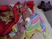 Yemen'de insanlık can çekişiyor