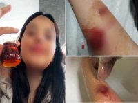 Köpek saldırısı sonucu üniversite öğrencisi kız yaralandı
