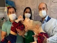 Brezilya'da yapışık ikizler başarılı ameliyatla ayrıldı