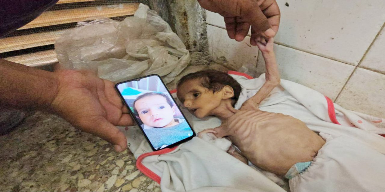 Gazze'de her gün 100'den fazla çocuk yetersiz beslenmeyle hastaneye yatırılıyor
