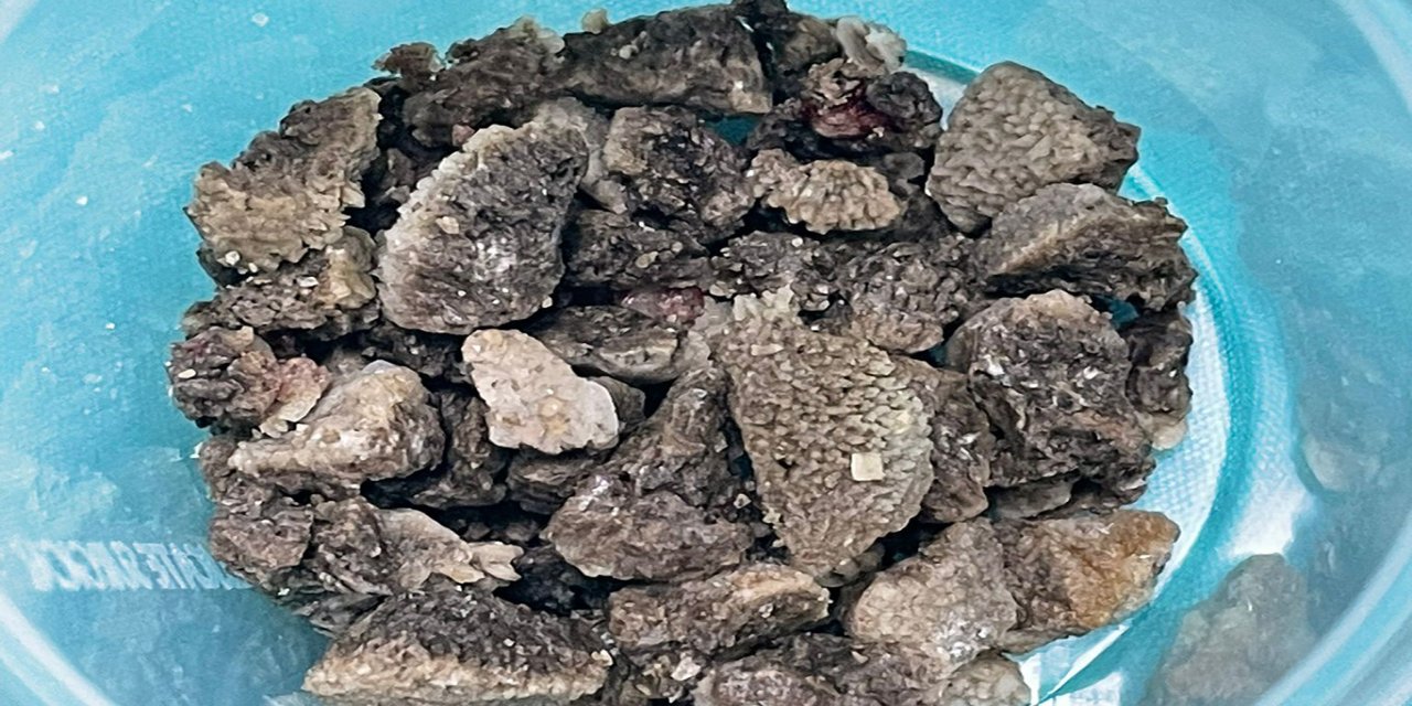 Malatya'da bir hasta, "Geyik boynuzu böbrek taşı"ndan ameliyatla kurtuldu