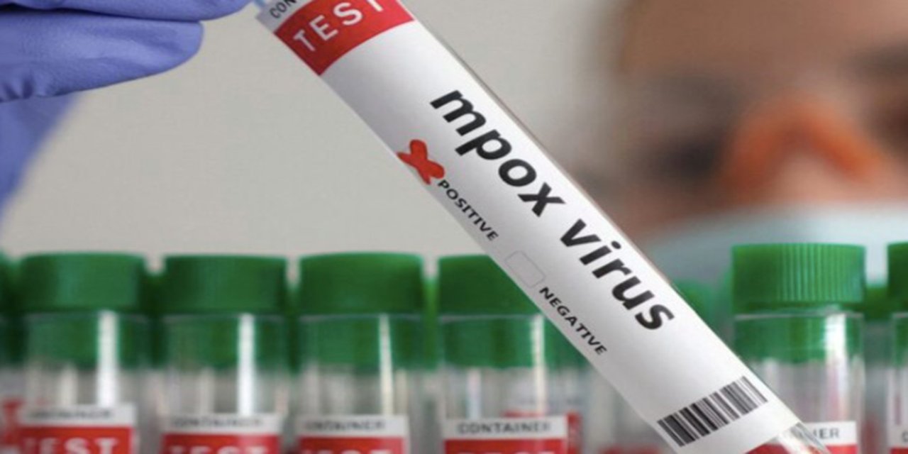 Namibya'da ilk M Çiçeği vakası tespit edildi