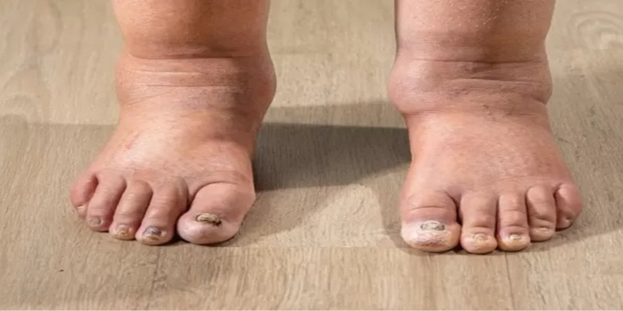 Kollarınızda veya bacaklarınızda şişlik varsa nedeni lenfödem olabilir!