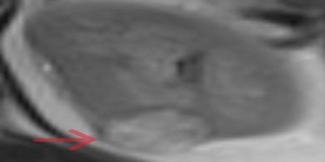 Laparoskopik Parsiyel Nefrektomi ile Ağrı'da bir ilk gerçekleştirildi!