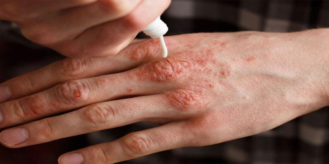 Soğuklarda cilt kuruluğuna karşı 10 tavsiye