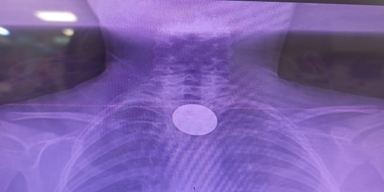 Siirt’te küçük çocuğun yuttuğu madeni para başarılı operasyonla çıkarıldı