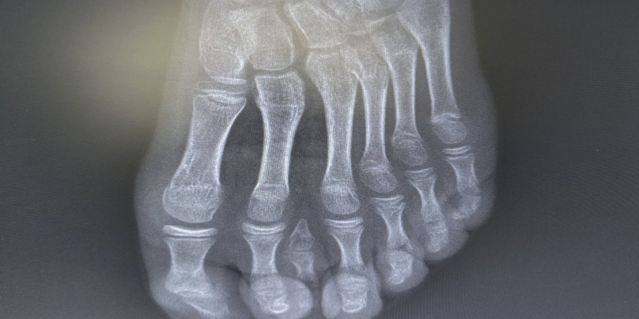 Batman'da nadir 7 parmaklı ayak vakası başarıyla tedavi edildi