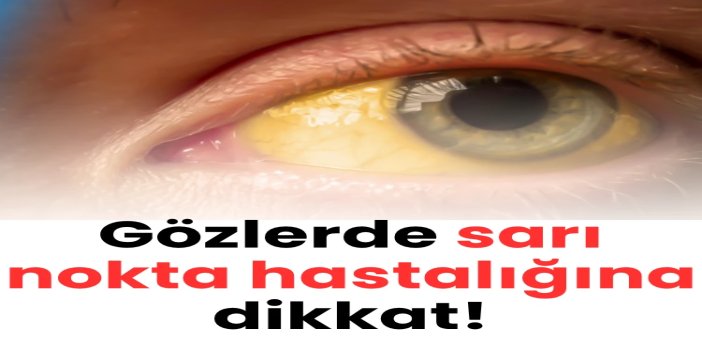 Gözlerde sarı nokta hastalığına dikkat!