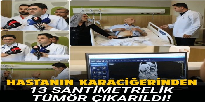 Gaziantep'te 77 yaşındaki hastanın karaciğerinden 13 santimlik tümör çıkarıldı