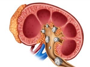 Böbrek taşı riskine karşı 7 önlem