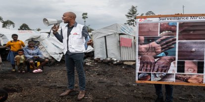 Kongo'da M çiçeği virüsü vaka sayısında artış