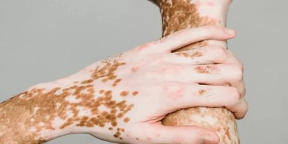 25 Haziran dünya vitiligo günü dolayısıyla farkındalık çağrısı
