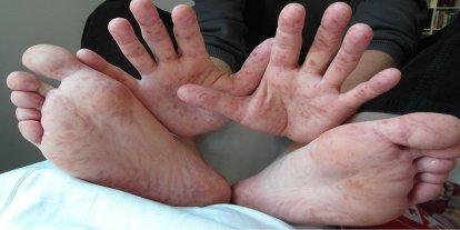 El, ayak ve ağız hastalığı çocuklar arasında çok hızlı yayılıyor