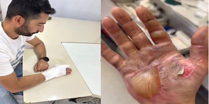 Telefon bataryası patladı tamirci yaralandı