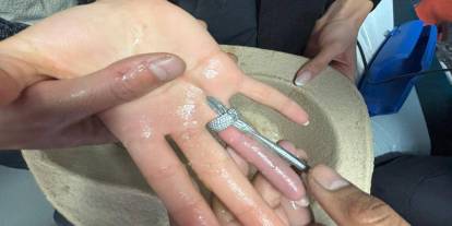 Parmağına sıkışan yüzük ifaiye ve doktorların müdahalesiyle çıkarıldı