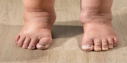 Kollarınızda veya bacaklarınızda şişlik varsa nedeni lenfödem olabilir!