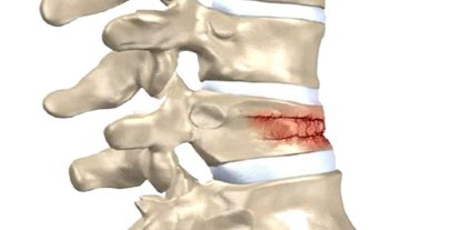 Omurga kırıkları kış aylarında artıyor