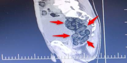 Otobüste yakalanan şahsın midesinden metamfetamin çıktı