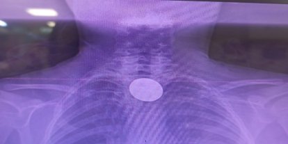 Siirt’te küçük çocuğun yuttuğu madeni para başarılı operasyonla çıkarıldı