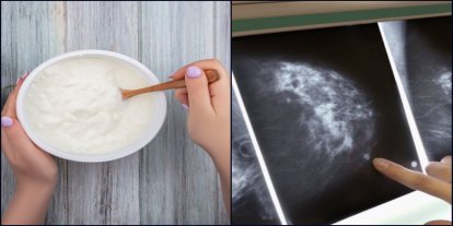 Yoğurt tüketimi meme kanserine karşı koruyucu olabilir mi?