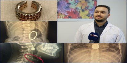 Op. Dr. Özkaya'dan çocuklarda yabancı cisim ve kimyasal madde uyarısı