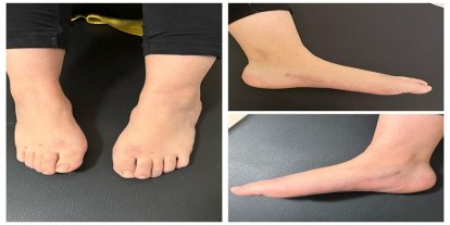 Şanlıurfa’da milyonda bir görülen hastalıkta umut veren başarı