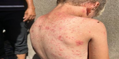 BM’den Gazze’de sağlık uyarısı