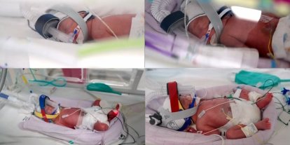 Avustralya’da tek yumurta dördüzleri dünyaya geldi