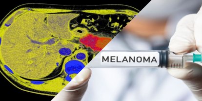 Kişiye özel kanser aşısı, melanomun tekrarlama riskini yüzde 42 azalttı