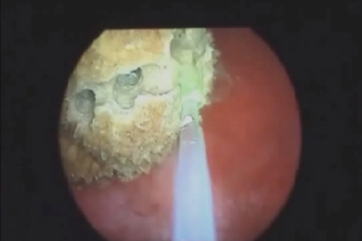 Böbrek taşı çocuklarda neden oluşur?
