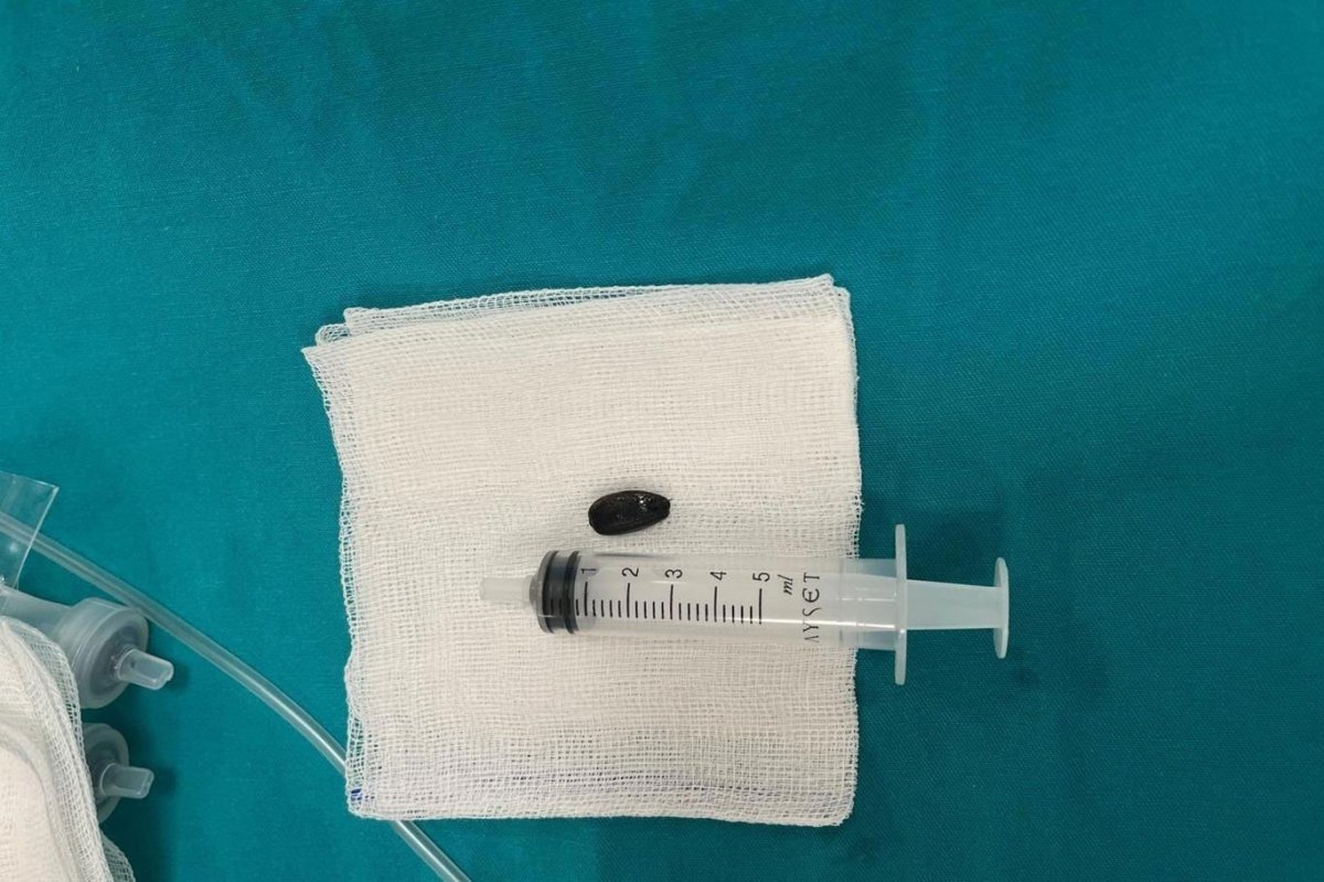15 aylık bebek Heimlich manevrasıyla hayata tutundu, acil ameliyatla kurtarıldı