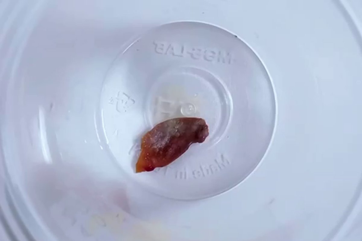 Bir buçuk yıllık öksürüğün sebebi kabak çekirdeği çıktı