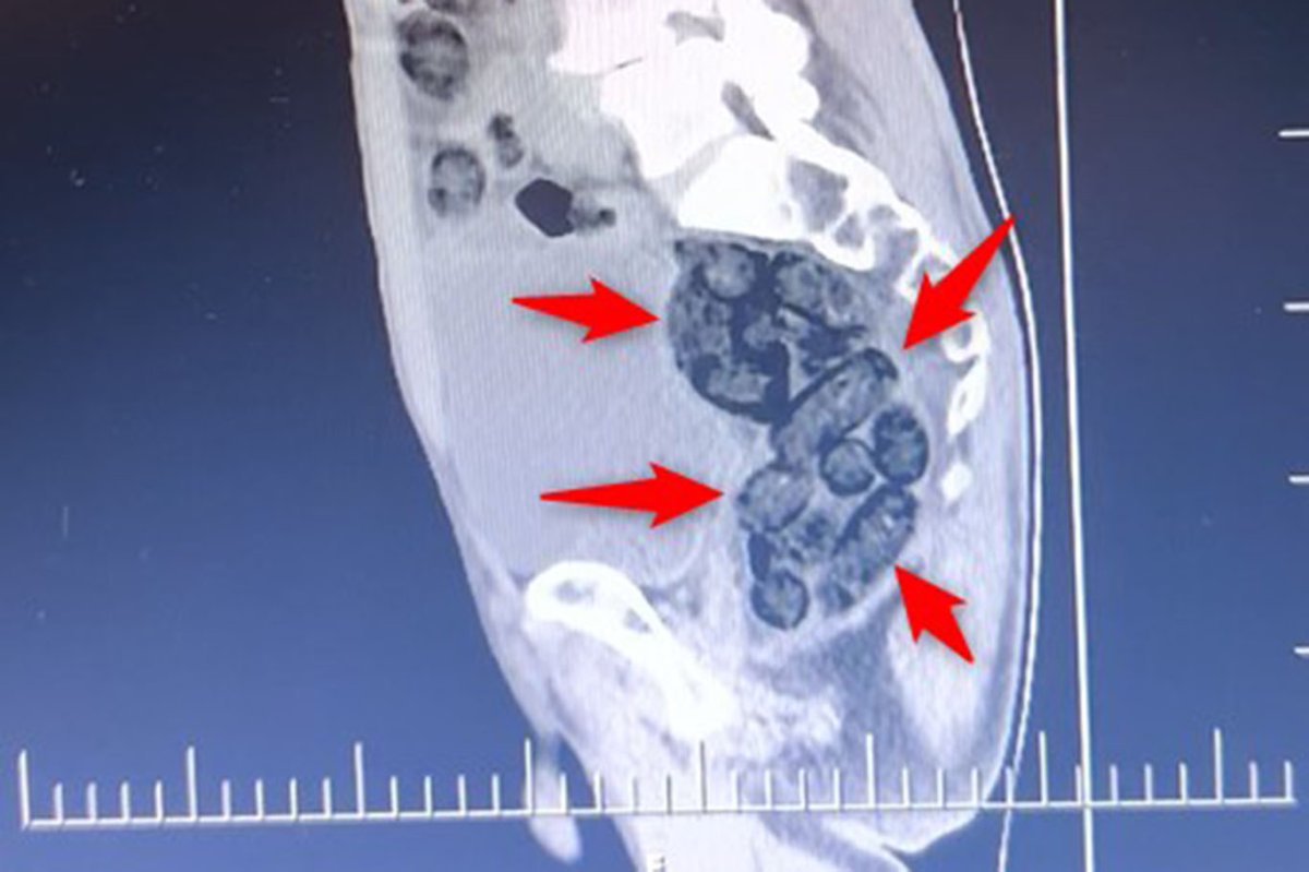 Otobüste yakalanan şahsın midesinden metamfetamin çıktı