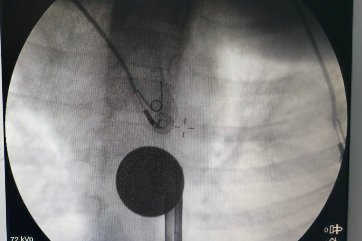 Siirt’te küçük çocuğun yuttuğu madeni para başarılı operasyonla çıkarıldı