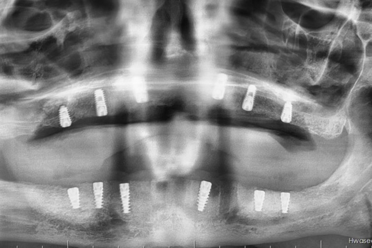 Batman'da kemik yetersizliği olan hastaya sinüs lift ameliyatı yapıldı