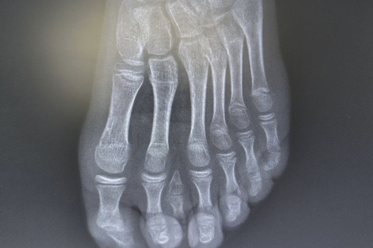 Batman'da nadir 7 parmaklı ayak vakası başarıyla tedavi edildi