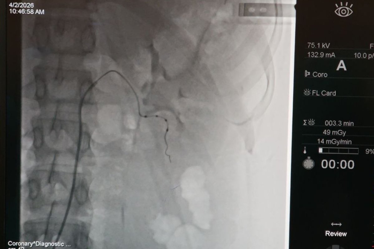 Malatya'da bir ilk: Dirençli tansiyon hastasına hayat değiştiren müdahale