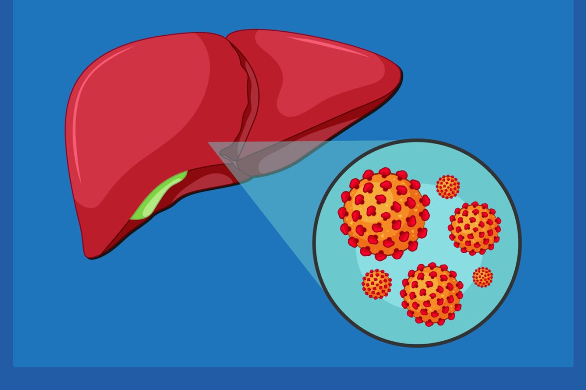Hepatit B uyarısı: Sessiz ilerleyen hastalık siroza kadar gidebiliyor