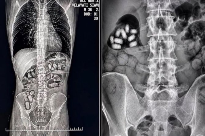 Havalimanında yutulan 60 kapsülde 495 gram metamfetamin ele geçirildi